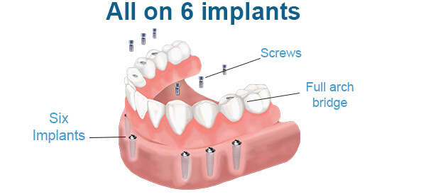 all-on-6-implant_01