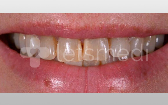 How much is a full set of veneers cost in Turkey? 5 before after images 1