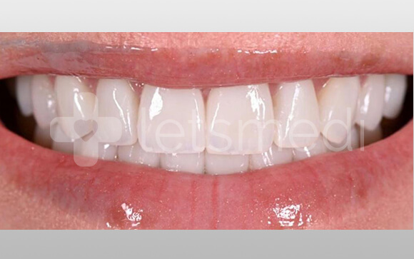 How much is a full set of veneers cost in Turkey? 6 before after images 10