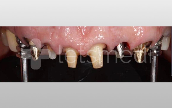 Full set of mouth dental implants cost Turkey 3 before after images 2