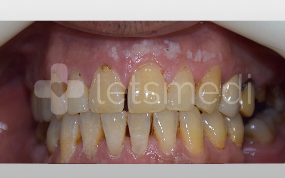 How much is a full set of veneers cost in Turkey? 3 before after images 4