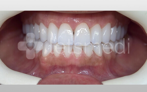 How much is a full set of veneers cost in Turkey? 4 before after images 5