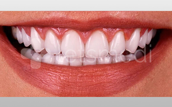 How much is a full set of veneers cost in Turkey? 2 before after images 6