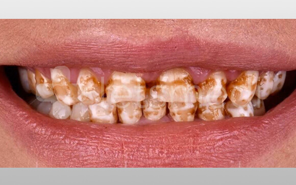 How much is a full set of veneers cost in Turkey? 1 before after images 7