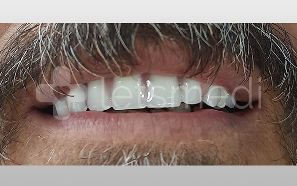 Full set of mouth dental implants cost Turkey 2 before after images 8