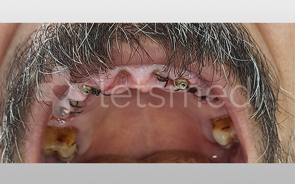 Full set of mouth dental implants cost Turkey 1 before after images 9