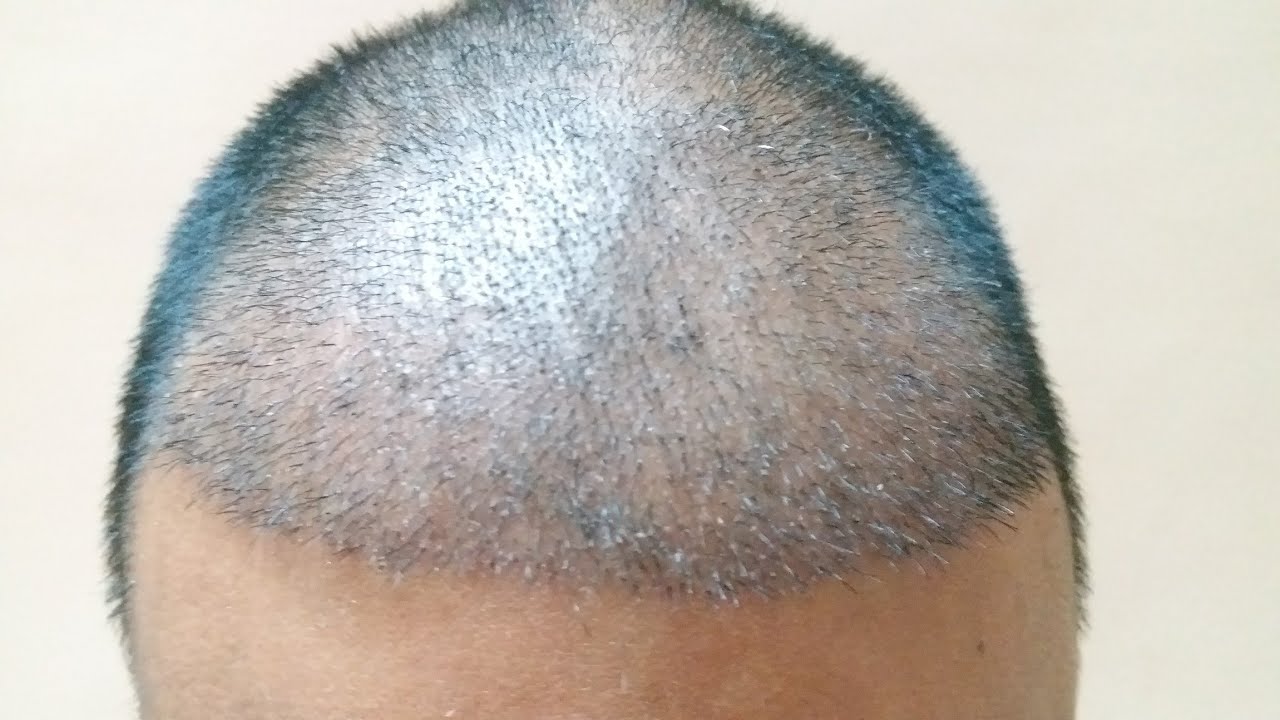 What Is The Fue Hair Transplant Procedure Technique Letsmedi Com