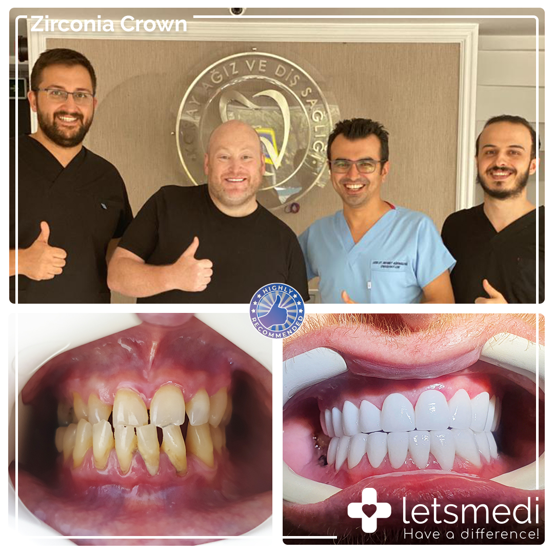 Zirconia Crown https://letsmedi.com/wp-content/uploads/2020/11/Zirconia-Crown-.jpg