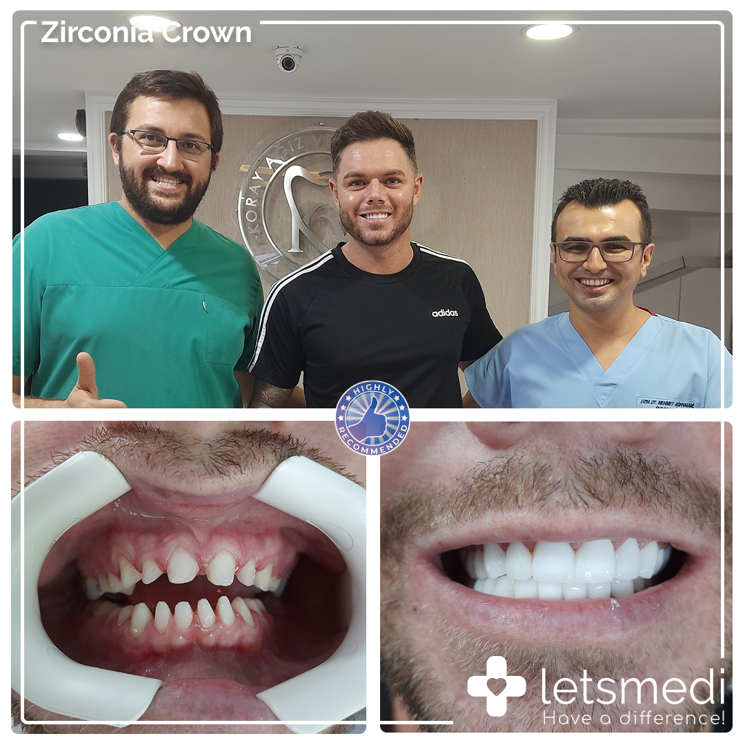 Zirconia Crown Mark https://letsmedi.com/wp-content/uploads/2020/11/Zirconia-Crown-Mark.jpg
