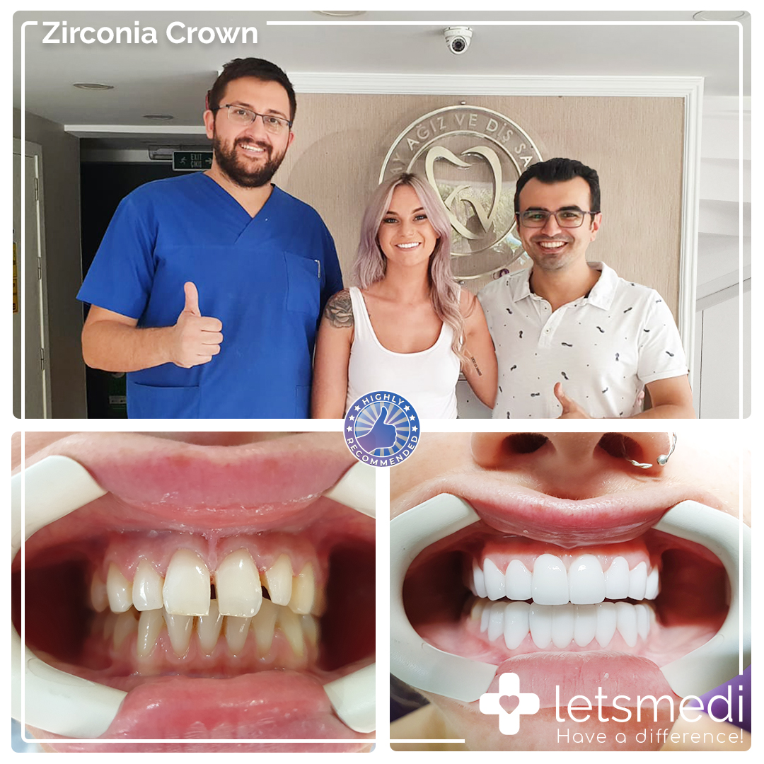Zirconia Crown Nicole https://letsmedi.com/wp-content/uploads/2020/11/Zirconia-Crown-Nicole.jpg