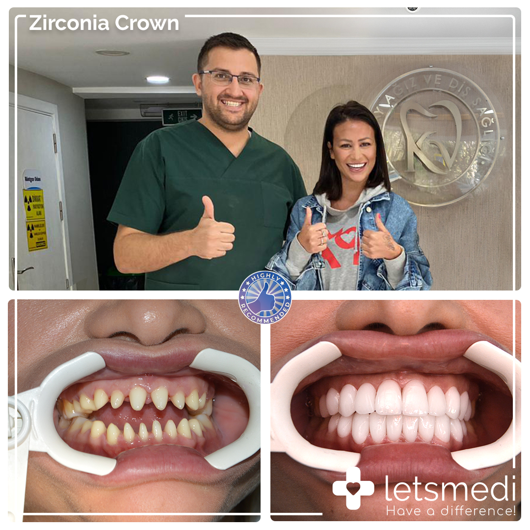 Zirconia Crown Sarah https://letsmedi.com/wp-content/uploads/2020/11/Zirconia-Crown-Sarah.jpg
