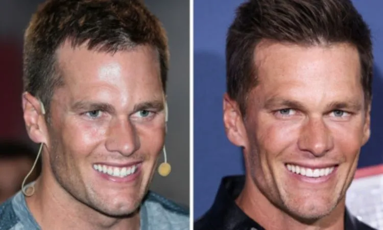 Tom Brady Veneers before and after