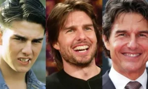 Tom Cruise Veneers before and after