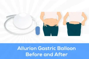 allurion gastric balloon before and after