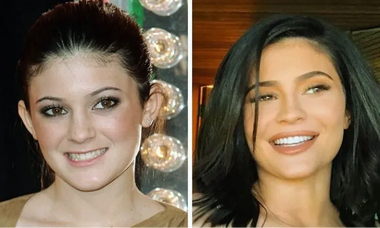 Kylie Jenner Veneers before and after