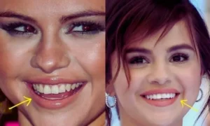 Selena Gomez Veneers Before and after