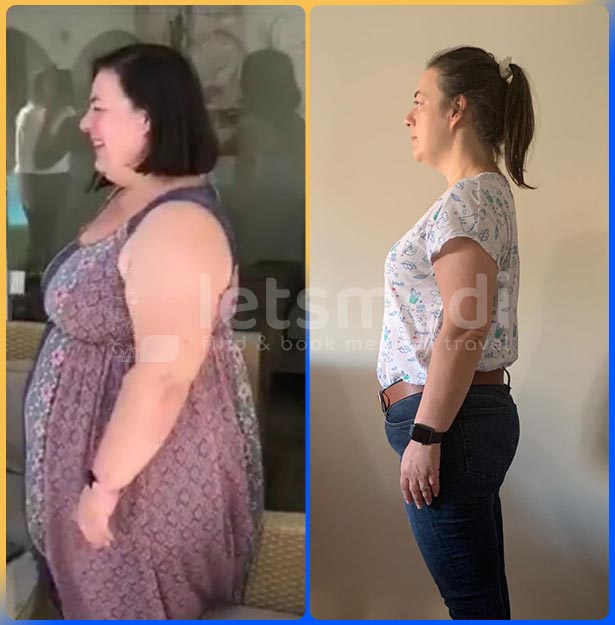 Gastric Sleeve Before and After Photos